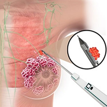 Core Biopsy in Vijayawada