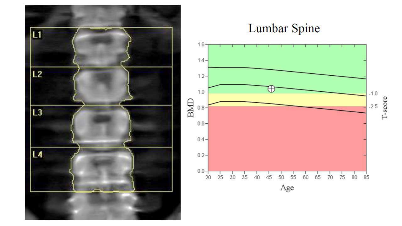 dexa scan in vijayawada