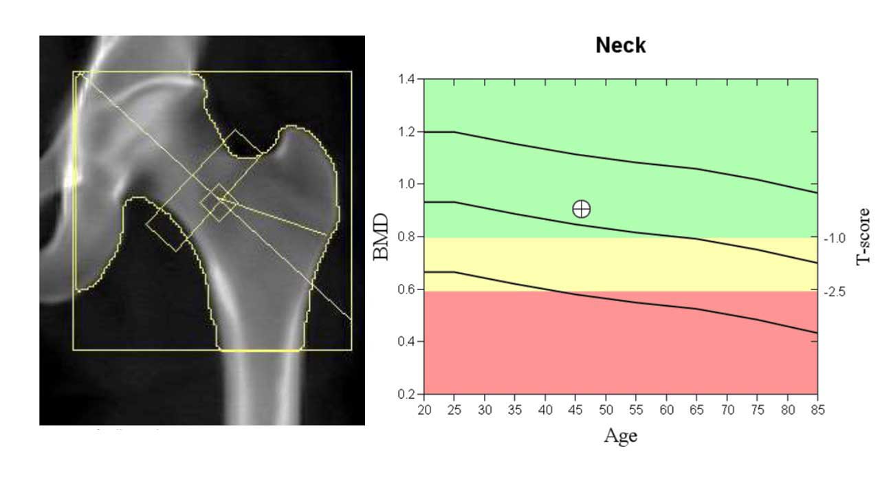 dexa scan in vijayawada